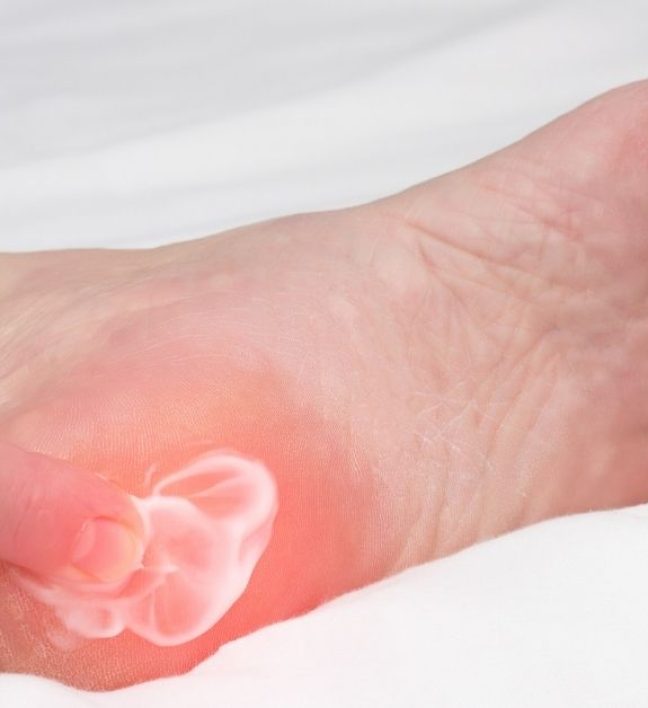 Topuk Kırığı Ameliyatı